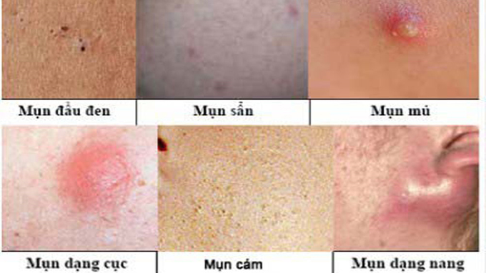Chăm sóc da mụn bạn nên biết về các loại mụn phổ biến