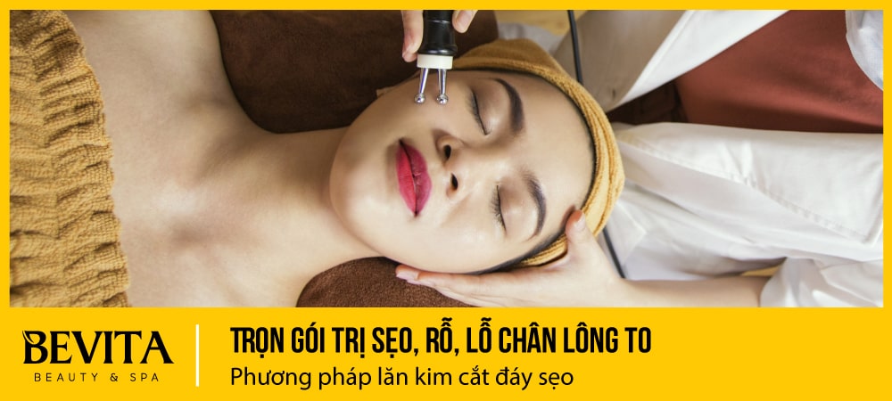 Điều trị sẹo lõm, rỗ, lỗ chân lông to bằng phương pháp lăn kim, cắt đáy sẹo