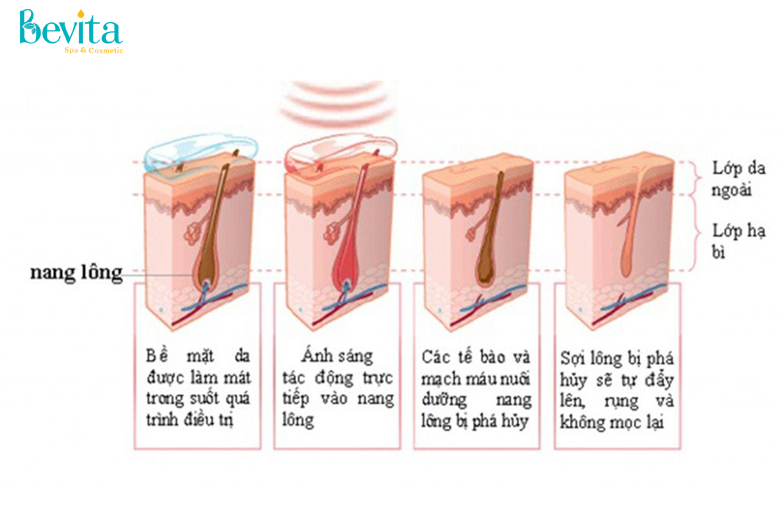 Ưu đãi dịch vụ triệt lông tận gốc vĩnh viễn mua 10 tặng 10 Bevita