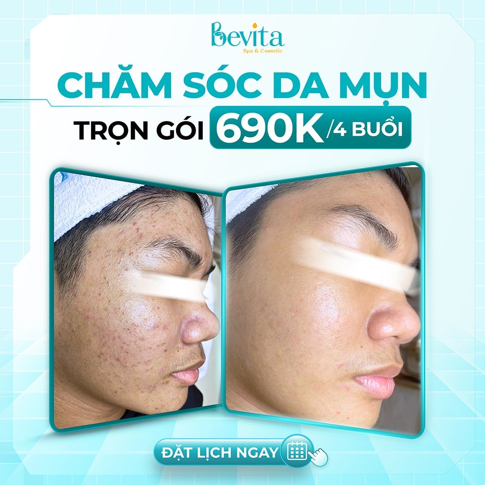 Giải Pháp Chăm Sóc Da Mụn Hiệu Quả – Tạm Biệt Mụn Với 690K/Tháng (4 Buổi) Tại Bevita, Gò Vấp